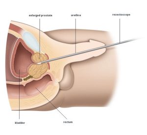 Image: Urethra Inserted With A Resectoscope